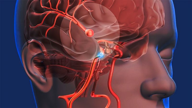 Colapso cerebrovascular