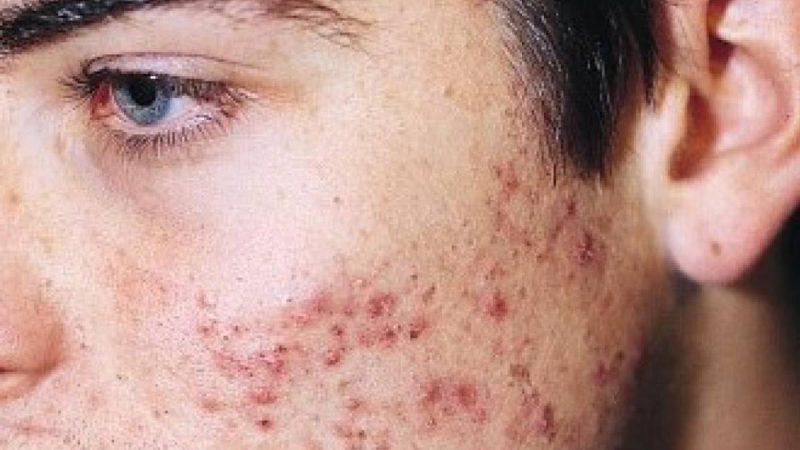 Las razones por las que no deberías volver a tomar lácteos 1 Merca2.es acne