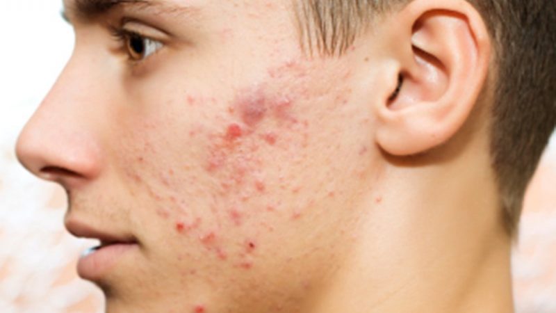 Alimentos prohibidos en tu dieta si quieres decir adios al acne Merca2.es