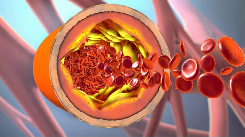 Hipercolesterolemia ¿Se produce por los quesos?