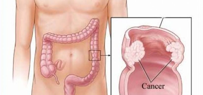 Cáncer: los cinco más mortales que puedes padecer 2 Merca2.es ¿Qué es el cáncer colorrectal?