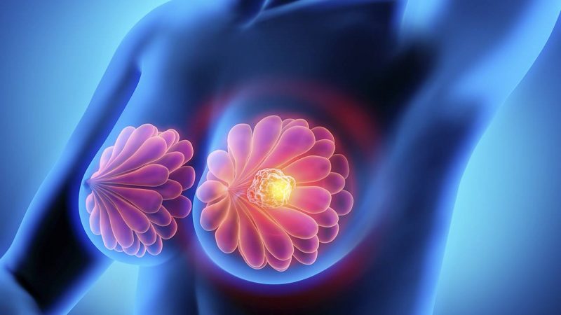 Cáncer: los cinco más mortales que puedes padecer 3 Merca2.es ¿Qué es el cáncer de mama?