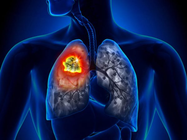 Cáncer: los cinco más mortales que puedes padecer 1 Merca2.es ¿Qué es el cáncer de pulmón?