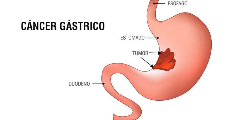 ¿Qué son los cánceres gástricos?