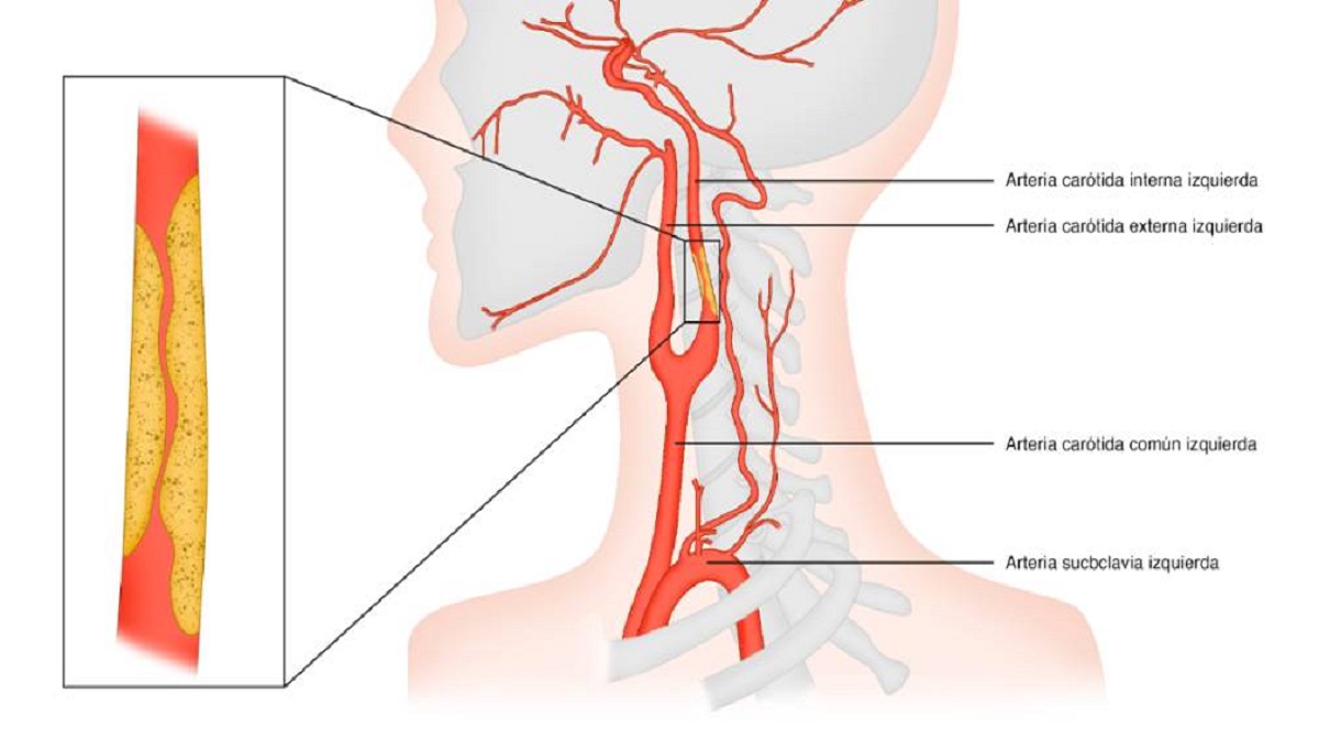 El Hospital Ruber Internacional opera con éxito un caso de estenosis carotídea posterior a radioterapia