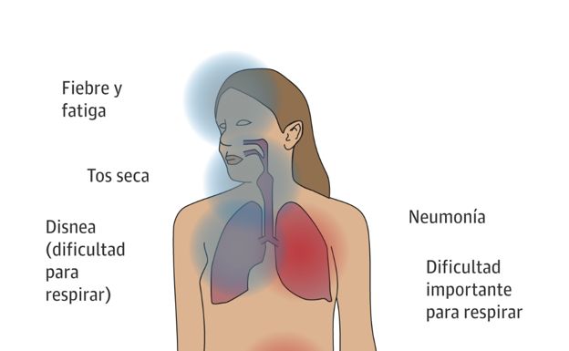 ¿Cuáles son los síntomas de la neumonía?