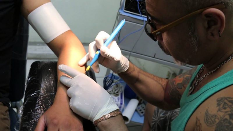 Mediante la técnica de remoción quirúrgica