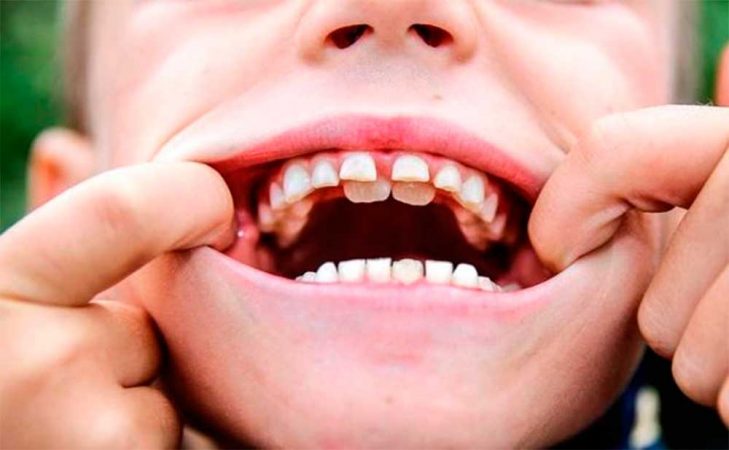 Daños en la dentadura azucar