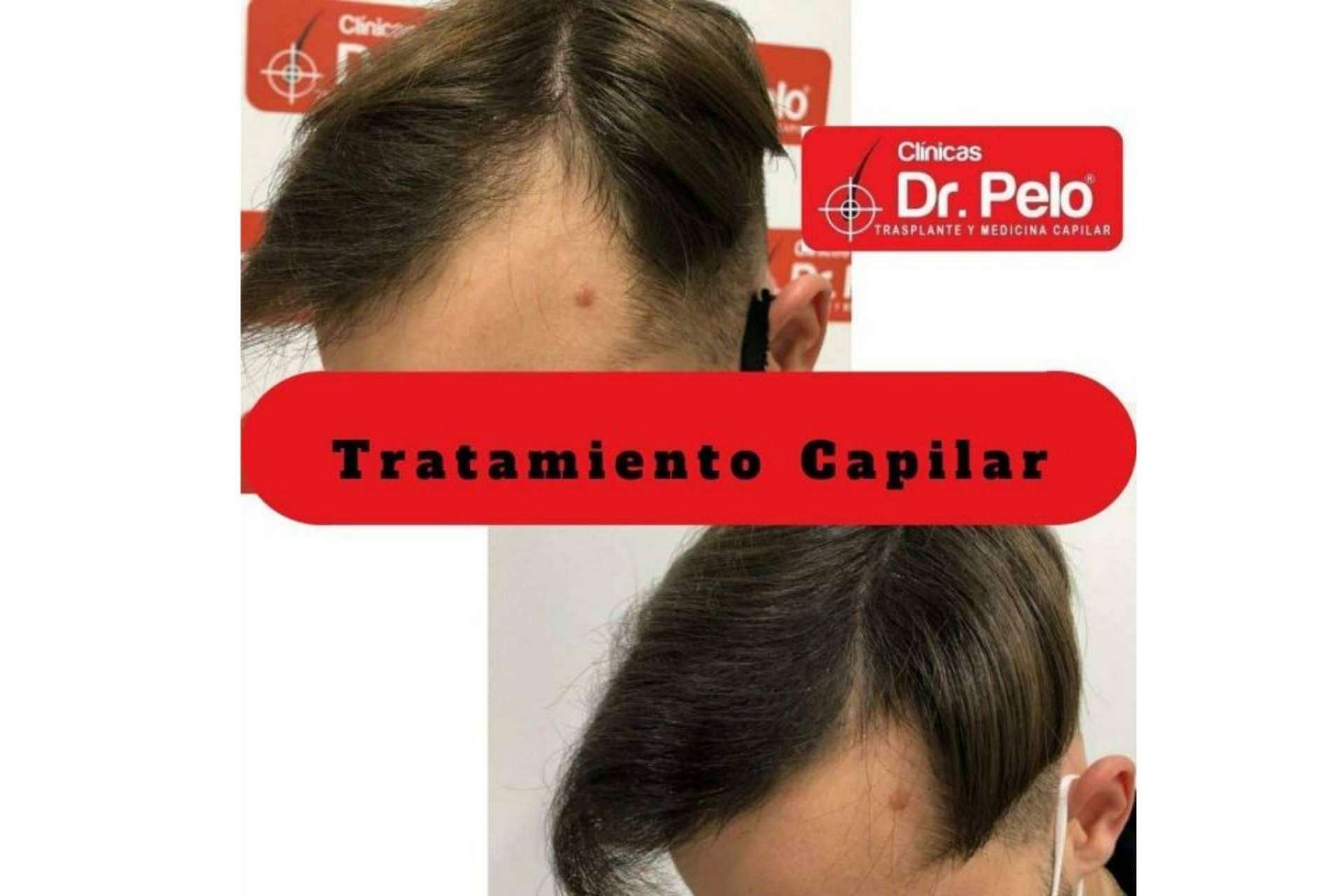 centro recomendado para obtener los mejores resultados de trasplante capilar en España