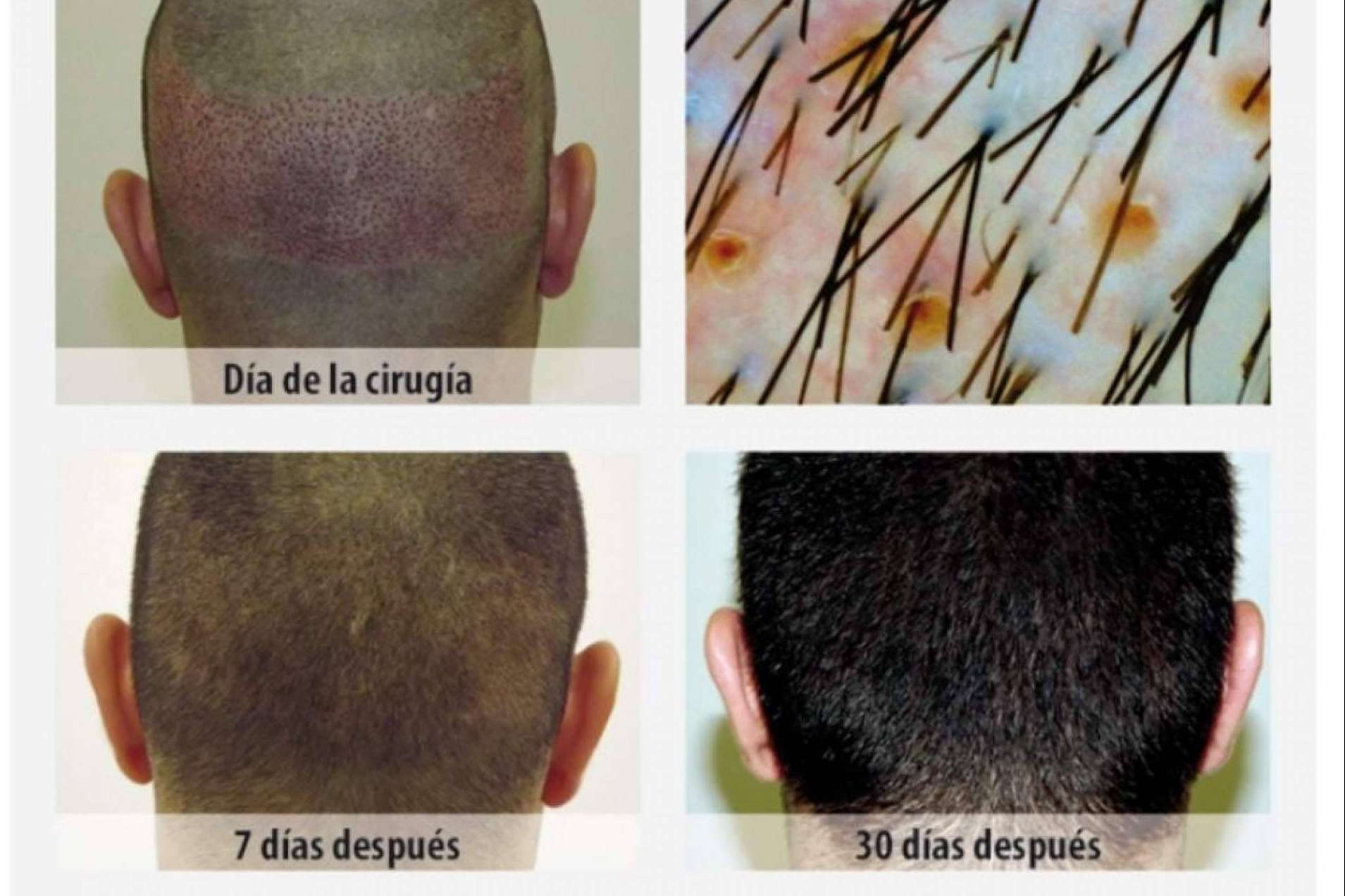 ¿Cuál es la mejor clínica de injerto capilar en Sevilla?: Clínica Dr.Pelo