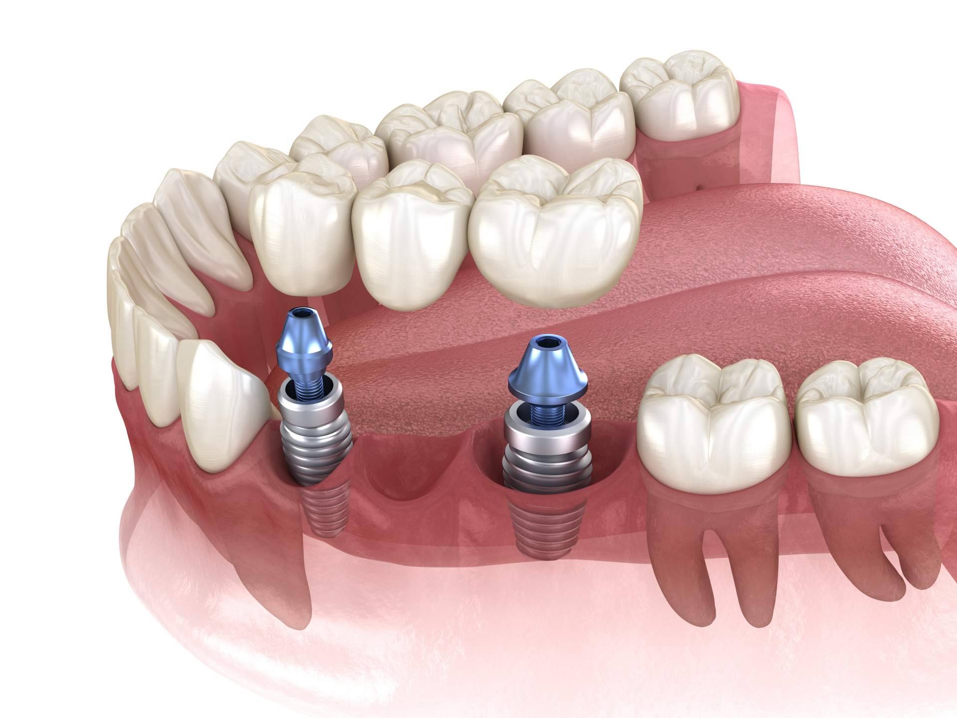 El implante dental de titanio V ha permitido recuperar la masticación y la sonrisa de miles de bocas gracias a la Clínica Artydents en Madrid