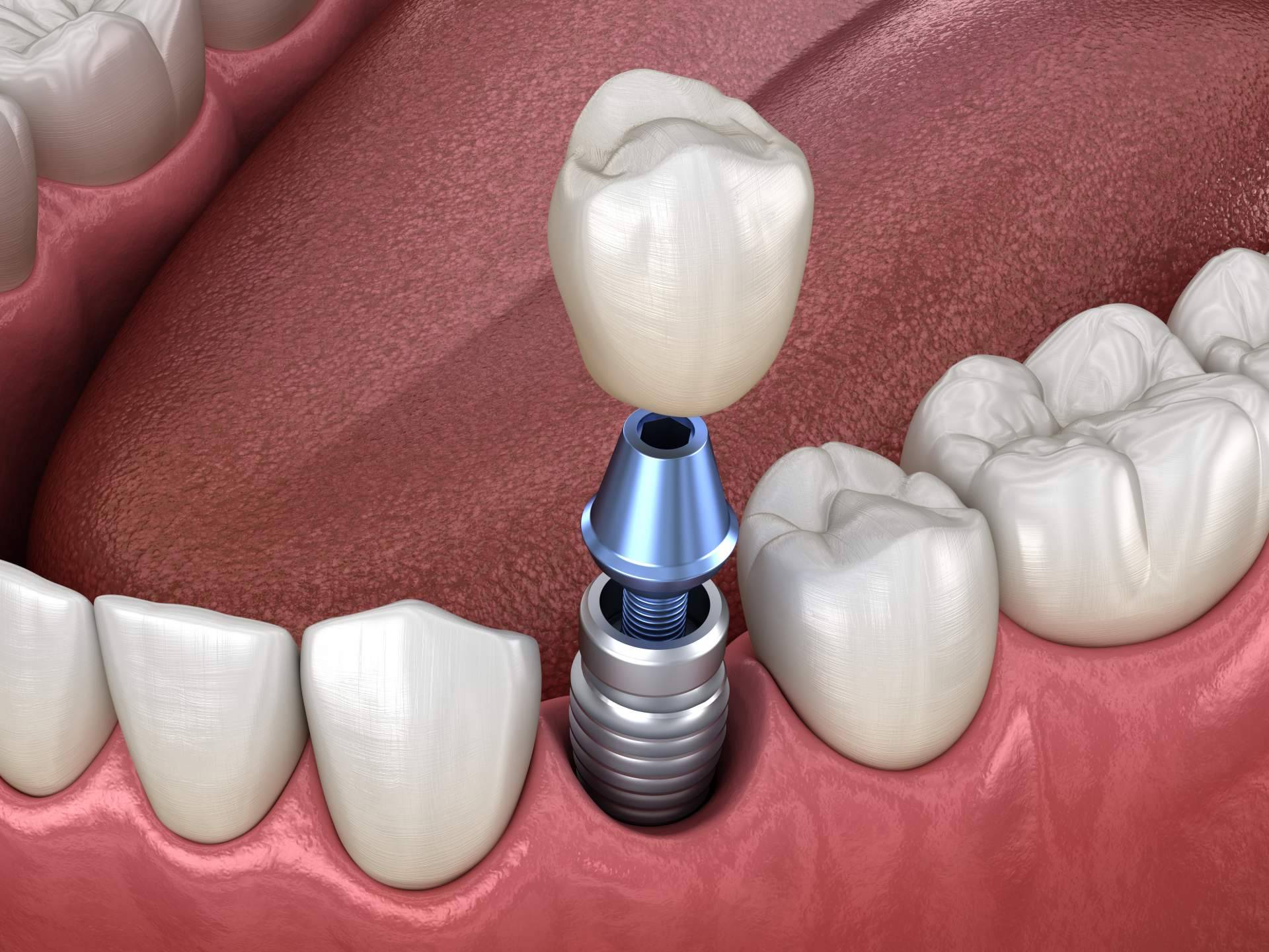 Ahora es posible tener los dientes fijos en un día con la Clínica dental especializada Artydents en Madrid