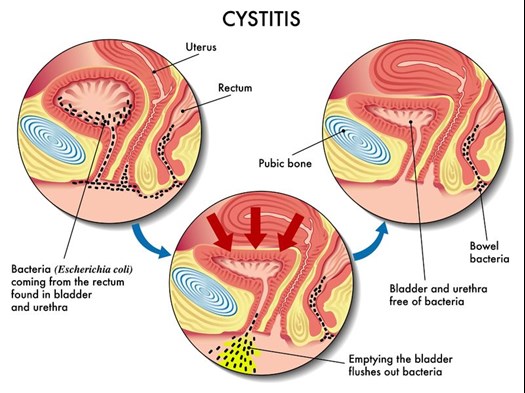 Cystitis