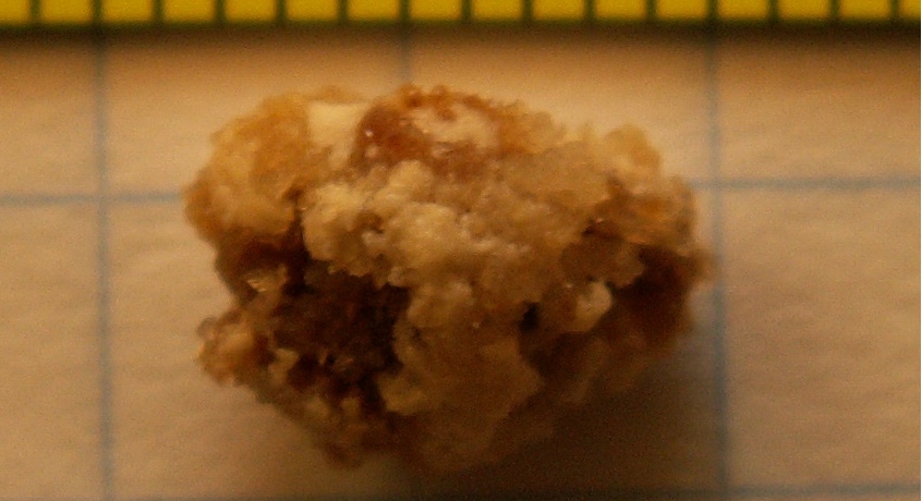 cálculo renal, piedra del riñón