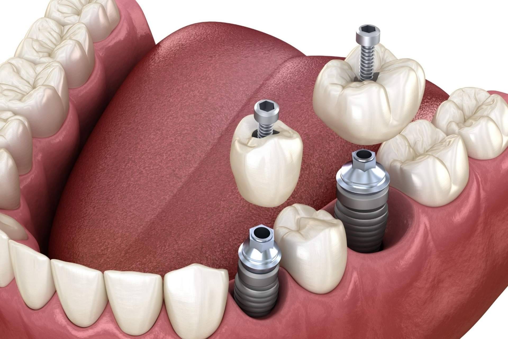 Los implantes de carga inmediata de Implant Clinics
