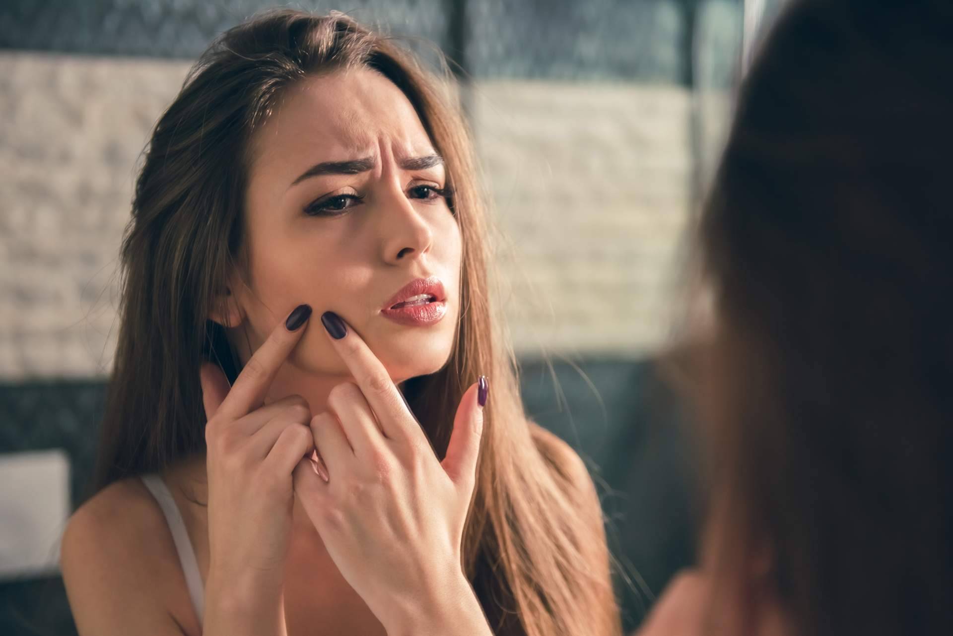 ¿Es posible quitar espinillas y granos?: Acné Xero