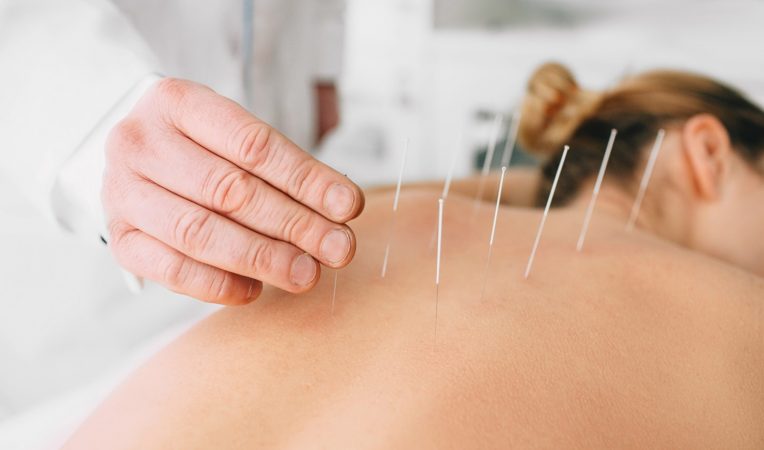 Acupuntura menouspasia