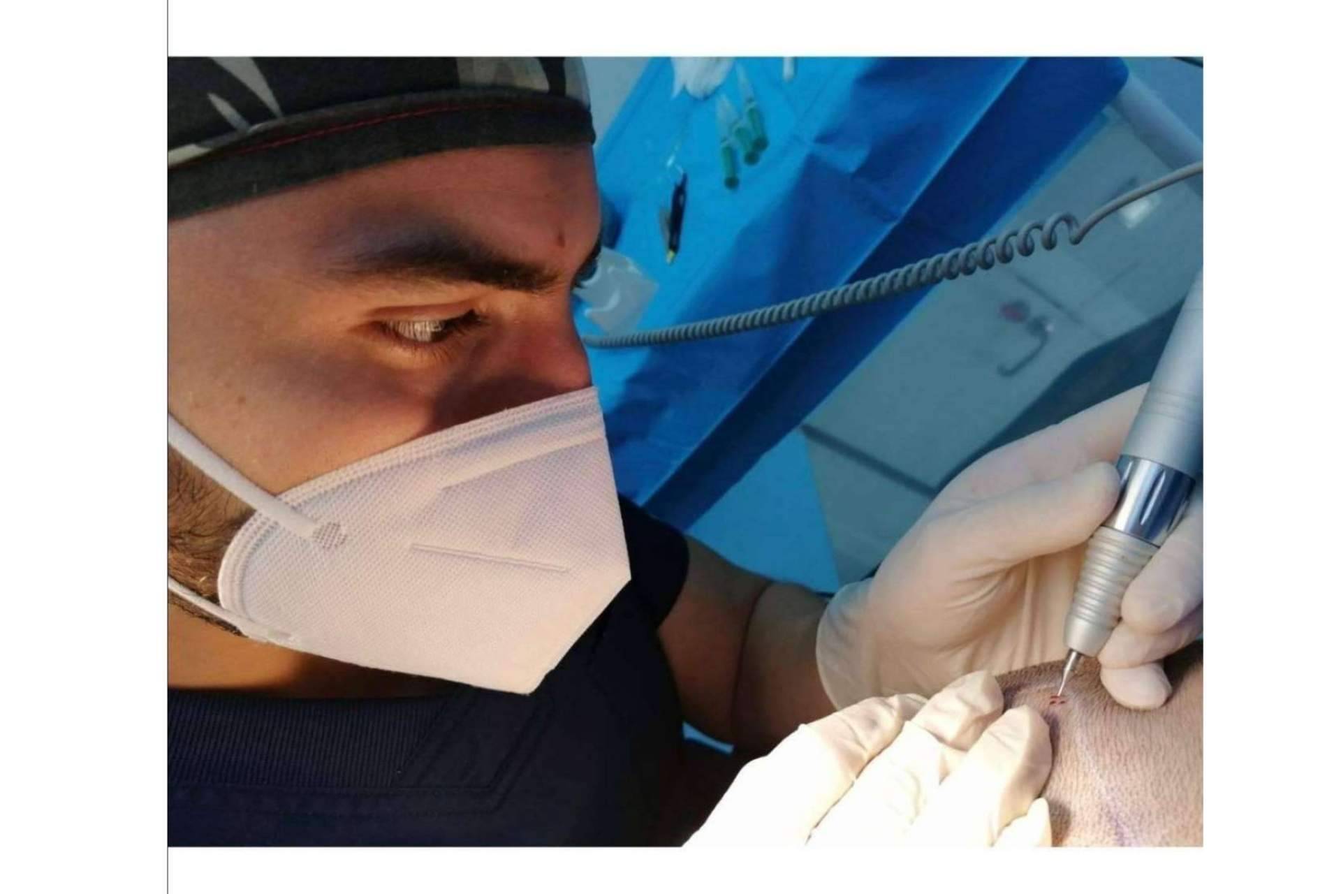 ¿Cuándo se cae el pelo implantado?, por Doctor Bern