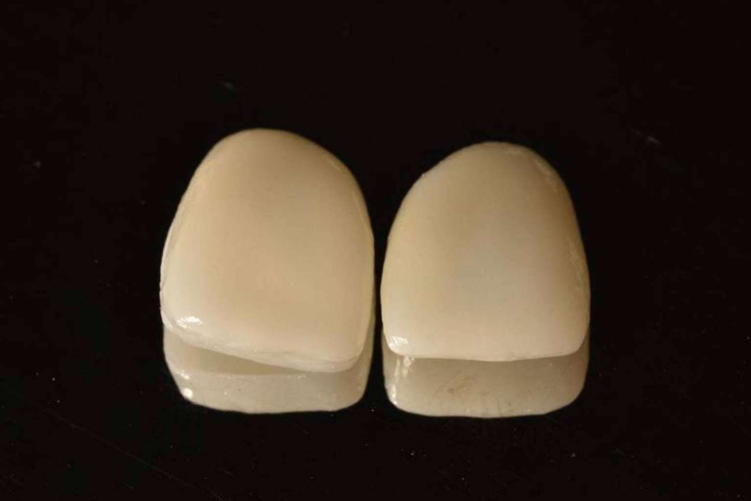 Tener una sonrisa perfecta con tratamientos 0 invasivos es posible con las carillas Emax y las inyectadas de composite de Implant Clinics