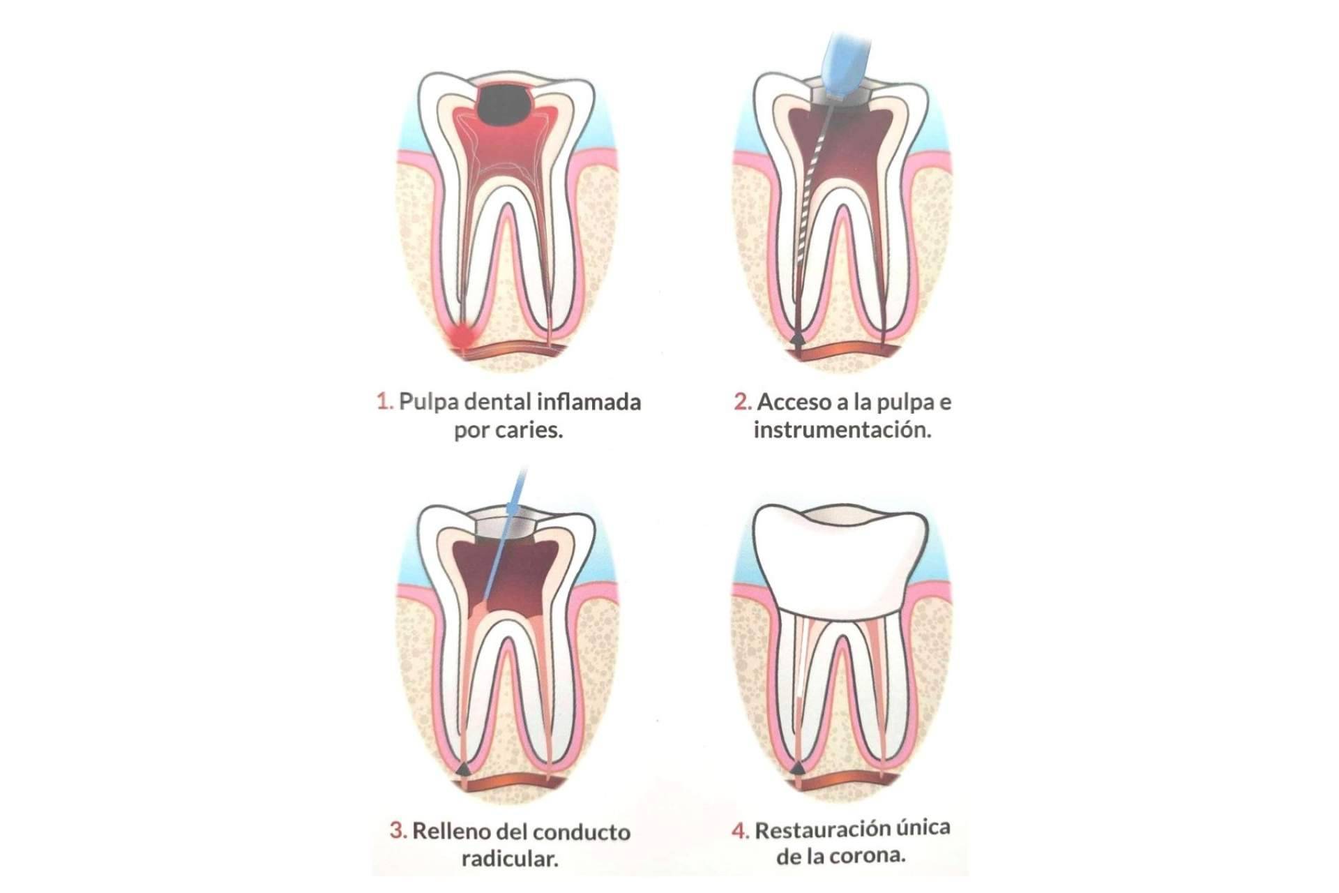 Los profesionales de Implant Clinics son expertos en la realización del procedimiento de endodoncia