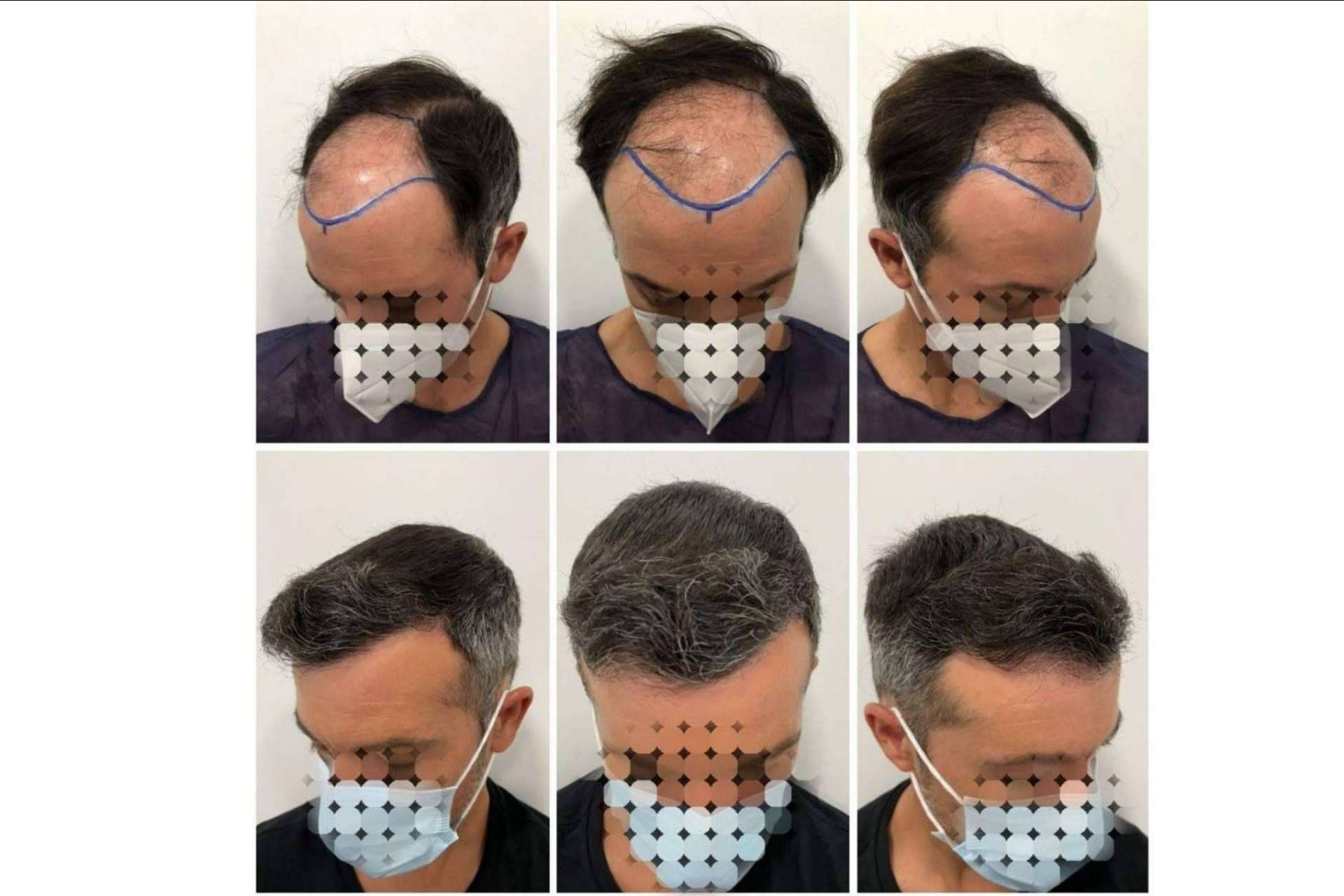 Dr. Bruno Jacobovski: tratamiento de mesoterapia capilar