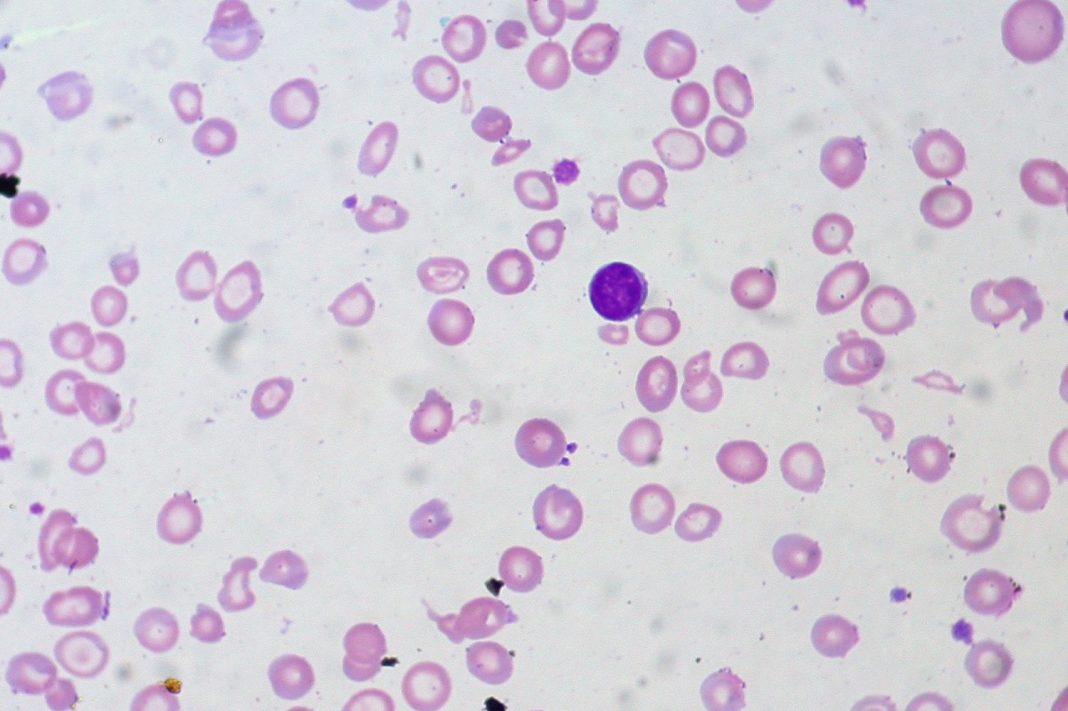 anemia