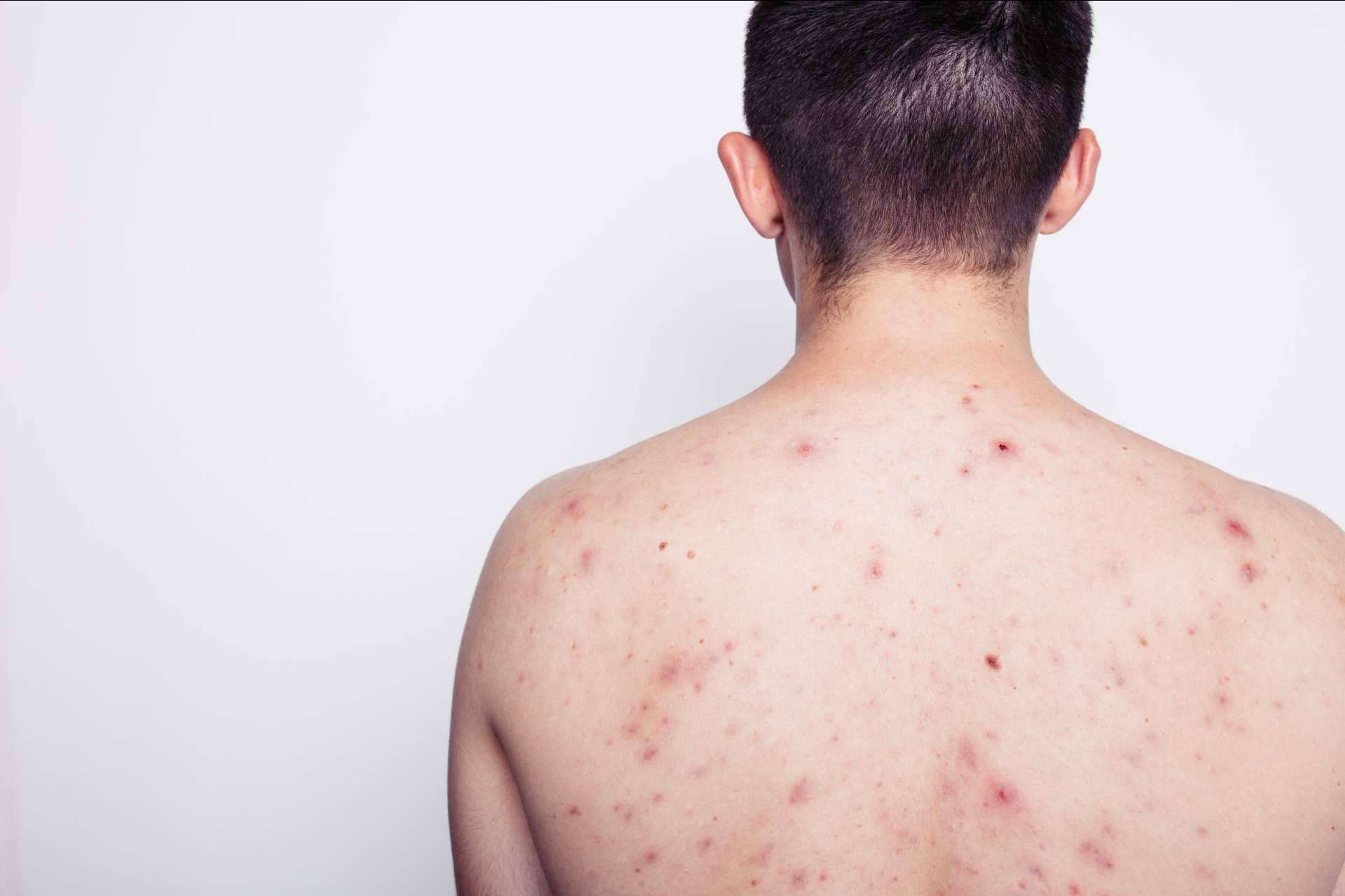 AcnéXero, la aplicación fundada por dermatólogos que propone soluciones efectivas para eliminar el acné