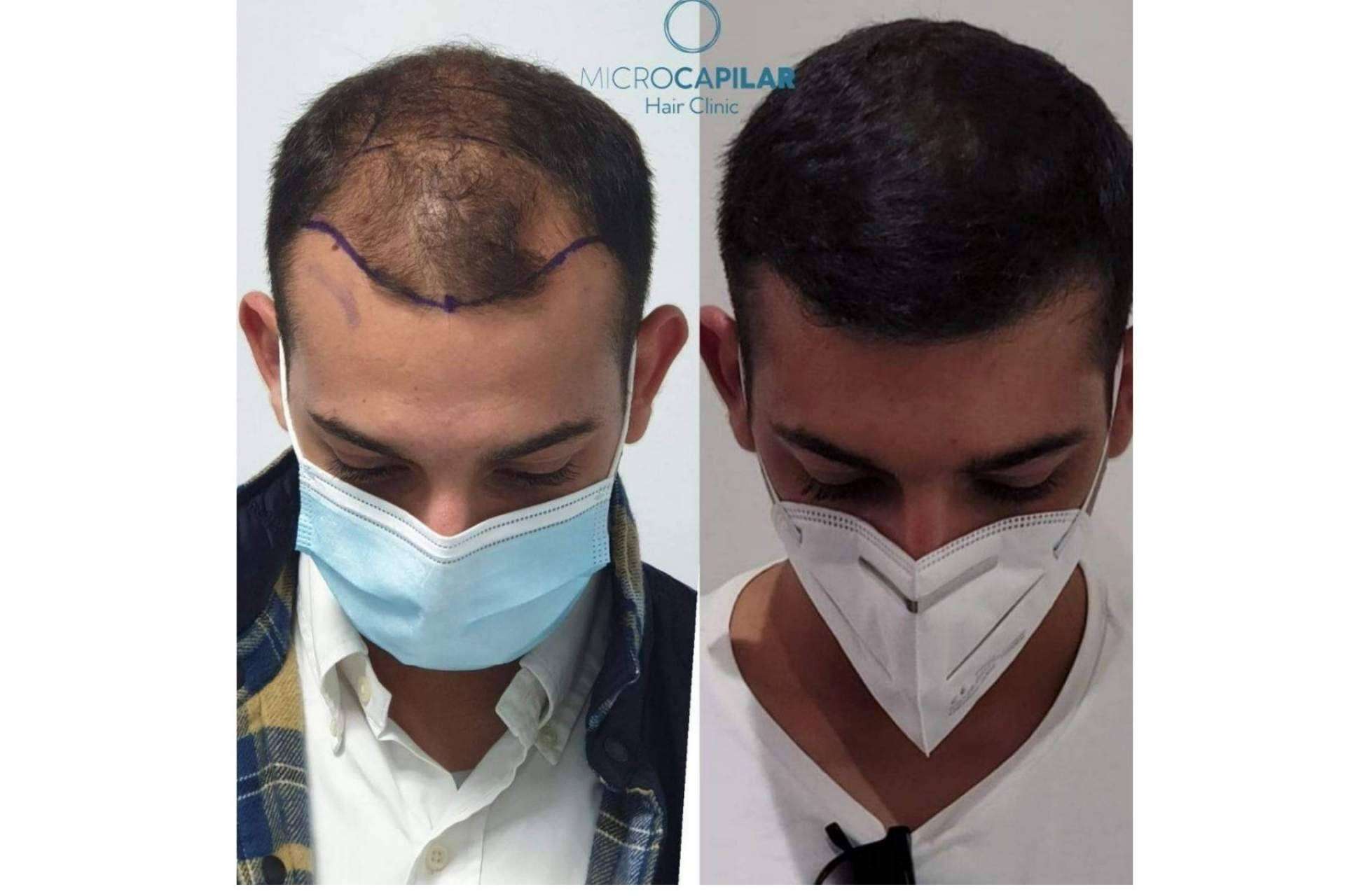 Las ventajas del servicio de Microcapilar Hair Clinic para realizar un injerto capilar en España