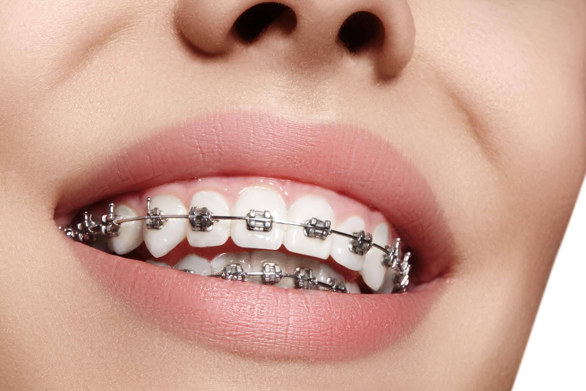 Clínica Sonrisas, en Badajoz, ofrece servicios de ortodoncia Insignia