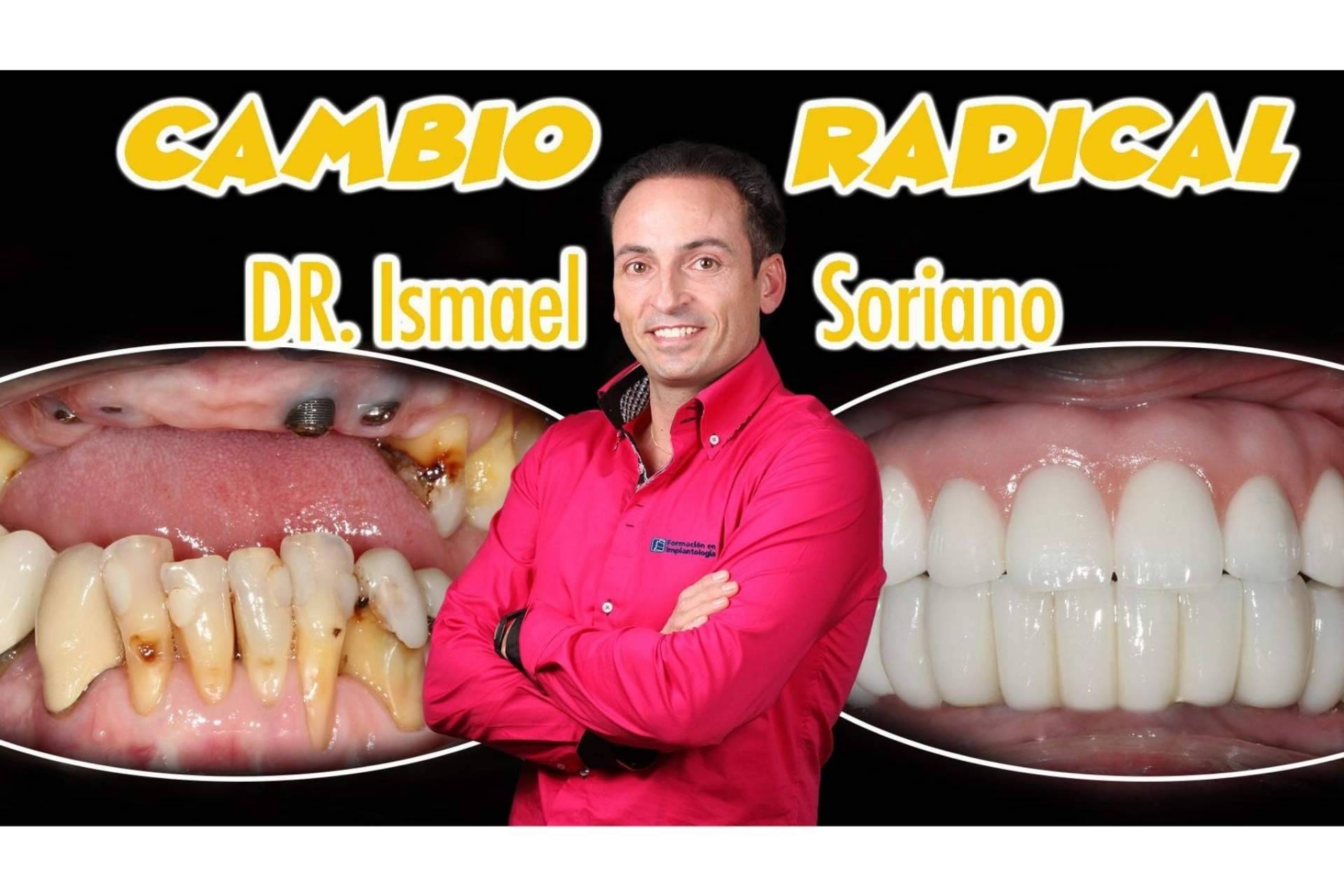 La técnica del Dr. Ismael Soriano que ofrece múltiples ventajas a los pacientes, los implantes con dientes inmediatos