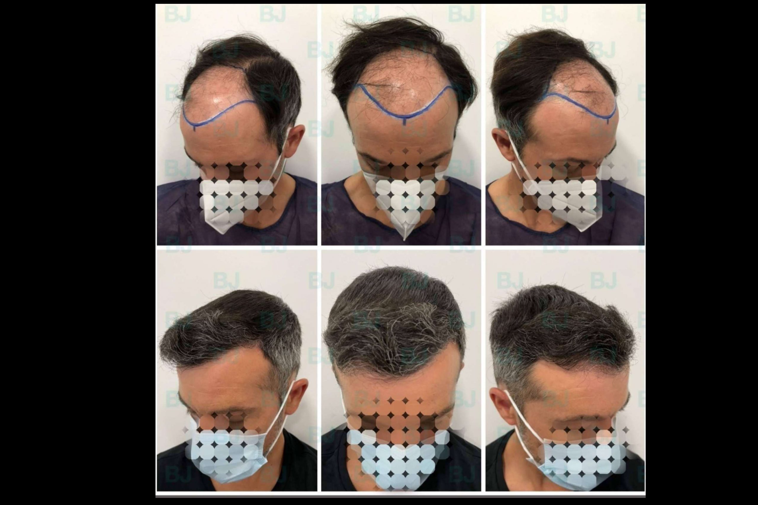 Dr. Bruno Jacobovski, especialista en injerto capilar en Barcelona con más de 500 intervenciones exitosas