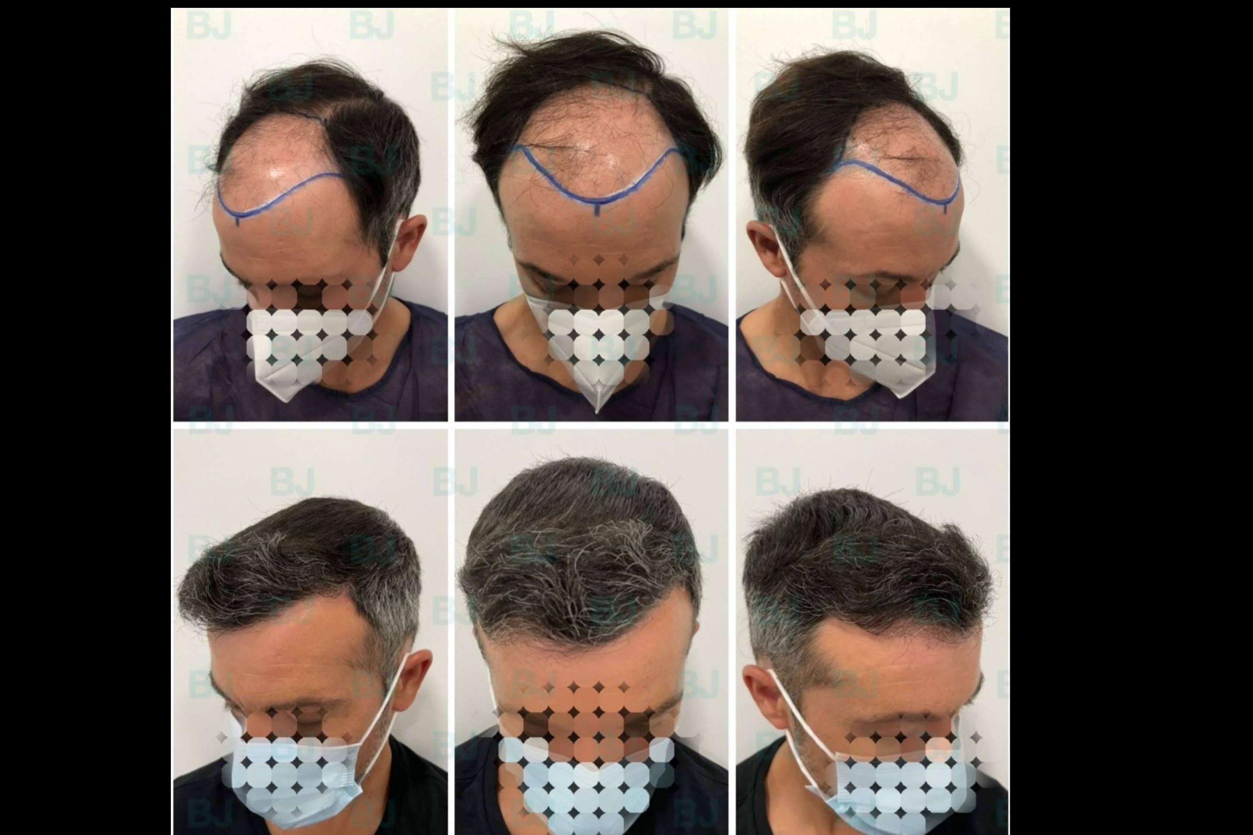 Dr. Bruno Jacobovski, uno de los pocos doctores en Europa que logra combinar las técnicas FUE y FUSS/FUT en la reconstrucción capilar de cicatrices y quemaduras