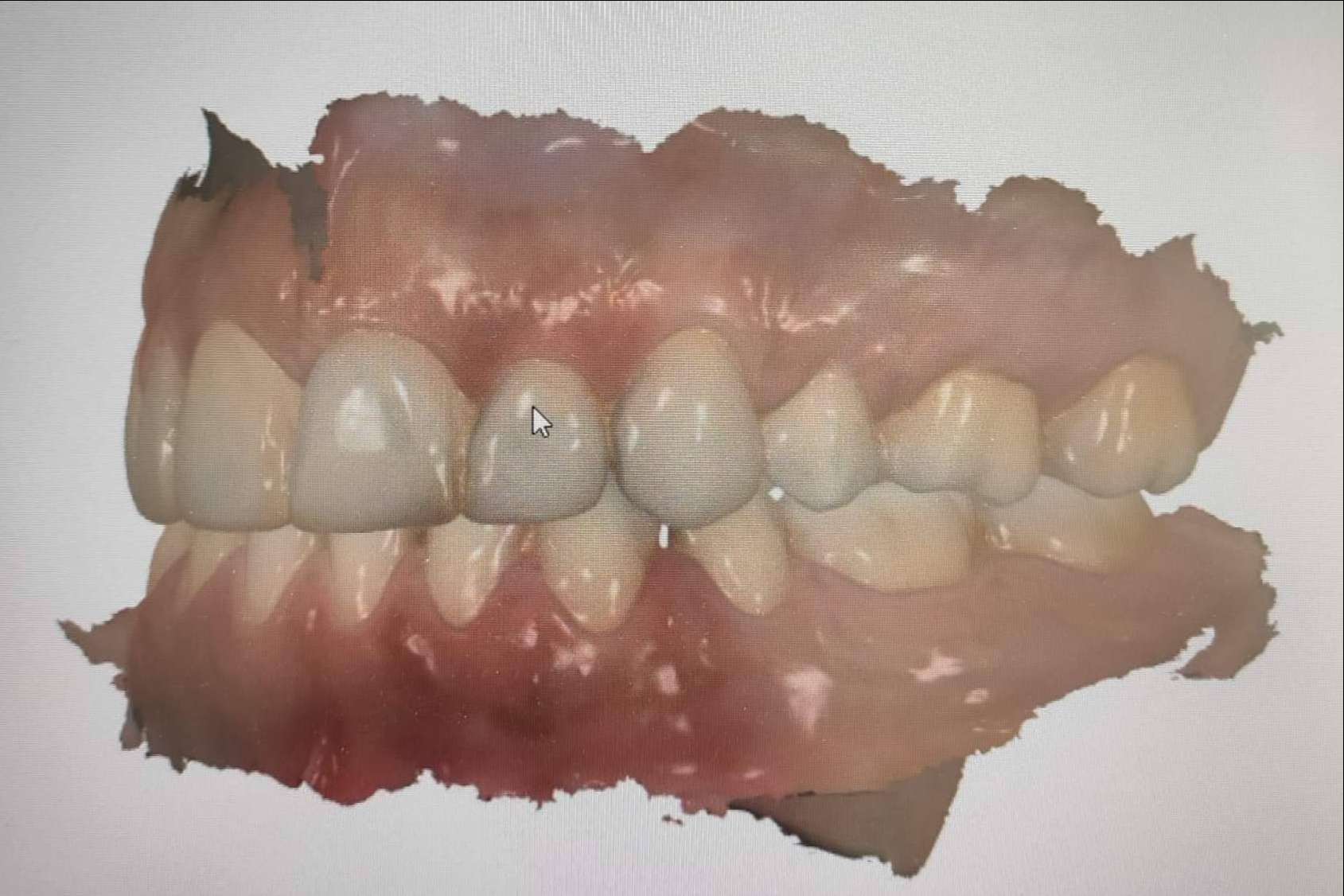 Las ventajas de la clínica dental Implant Clinics en la toma de registros con 3Shape TRIOS, un escáner de última tecnología