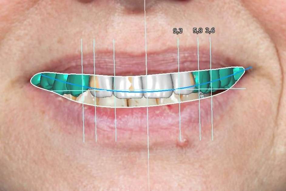 La Clínica Blay+Monzó es especialista en el diseño de sonrisas
