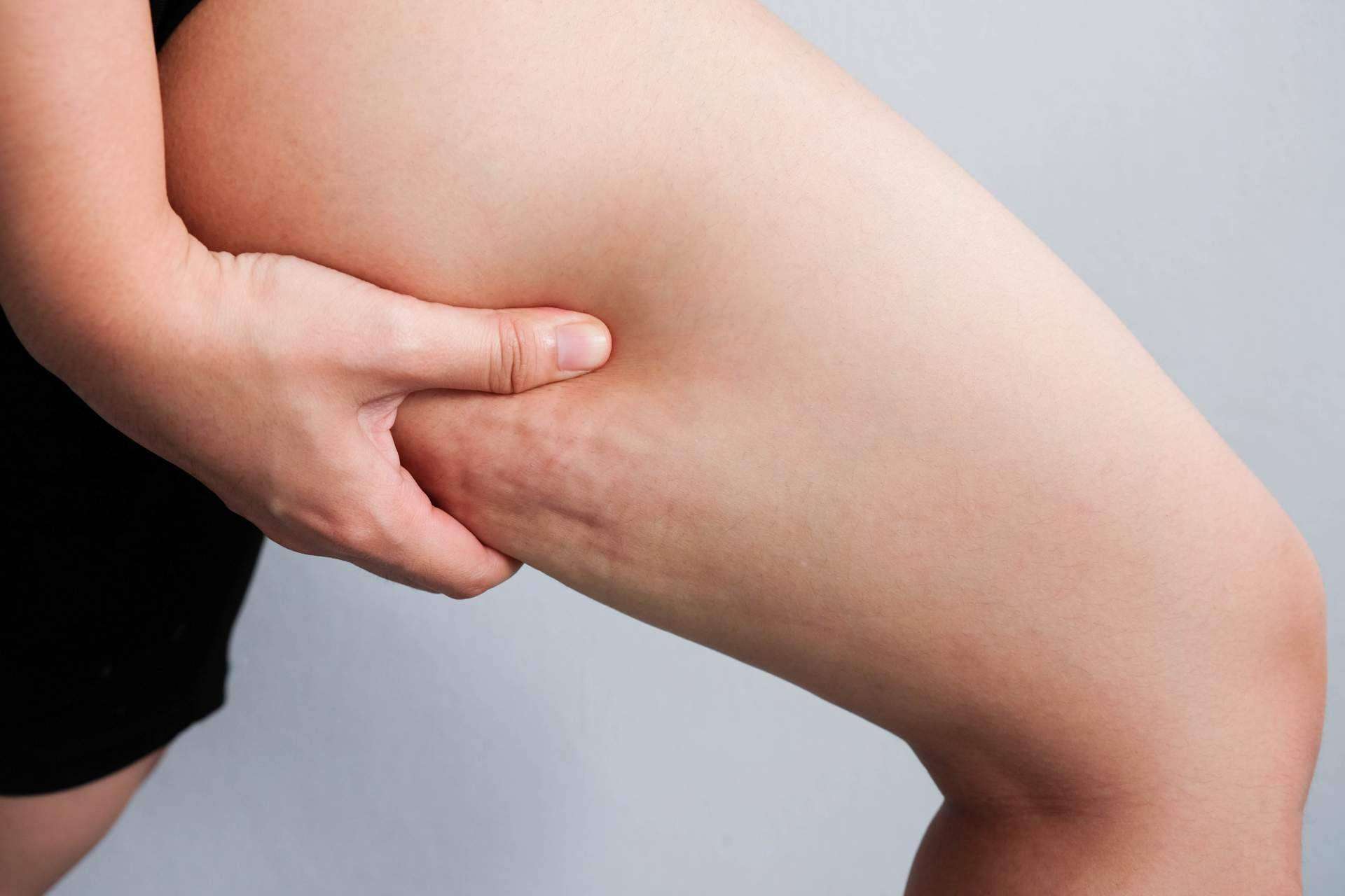 ¿Cómo combatir la celulitis de una forma natural?, por Sincelut Forte