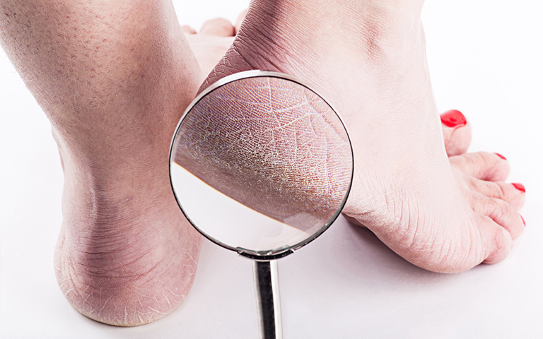 Trucos para acabar con los pies secos o agrietados