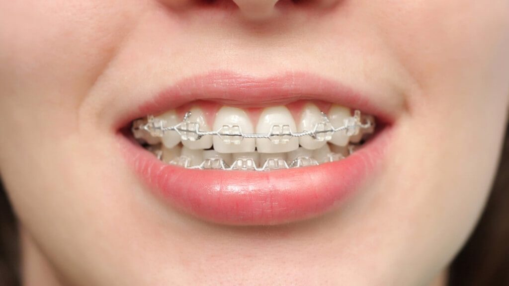 Cosas que no puedes comer con brackets