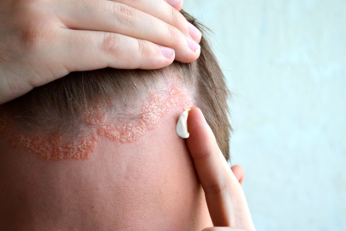 Dermatitis seborreica  estrés