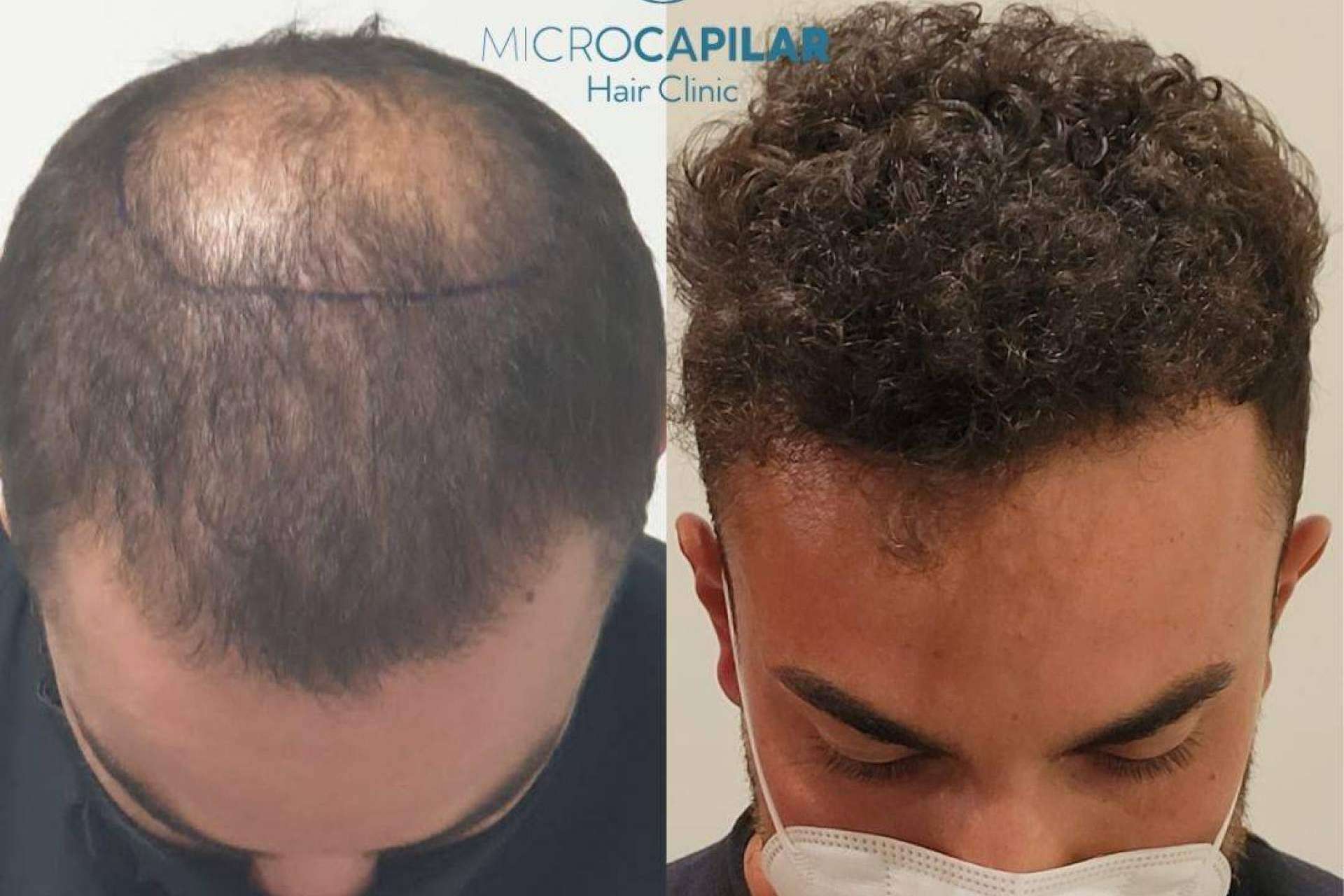 Un lugar para realizarse un injerto capilar con máxima extracción folicular es Microcapilar Hair Clinic