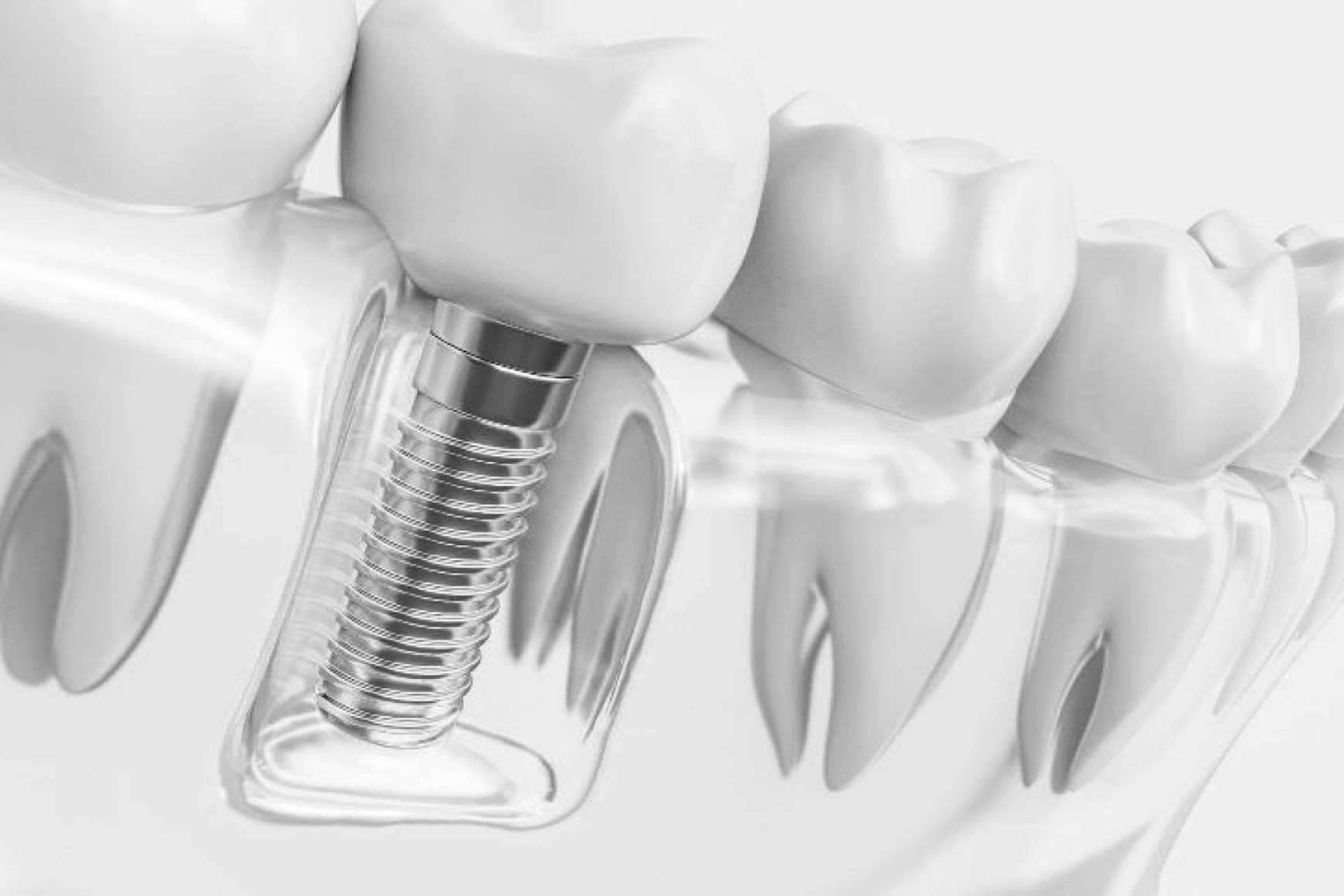 Grupo Gente Vital ofrece tratamientos de calidad de ortodoncia invisible
