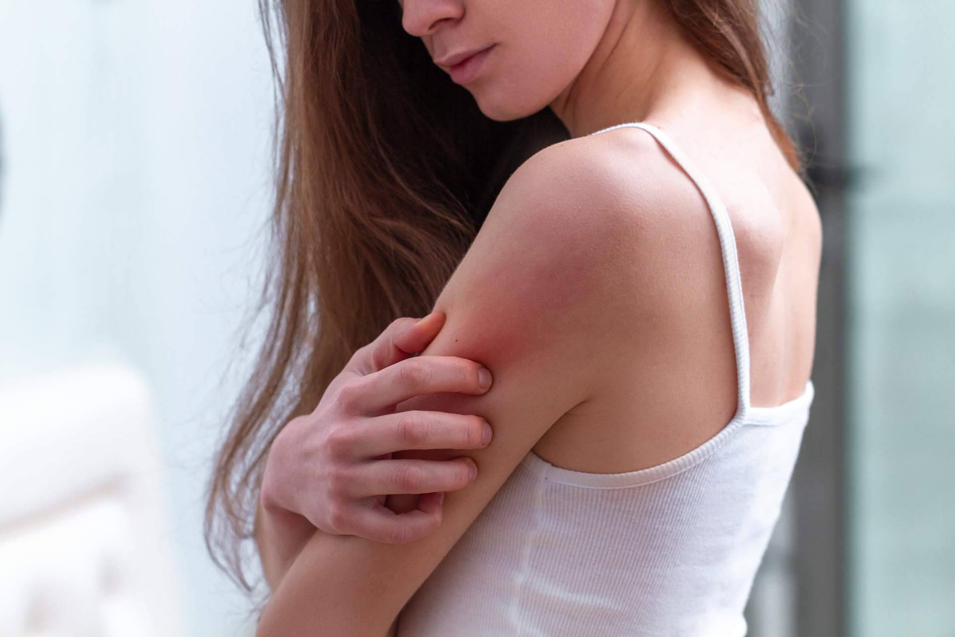 Laboratorio Géomer ofrece un tratamiento natural psoriasis corporal sin cortisona