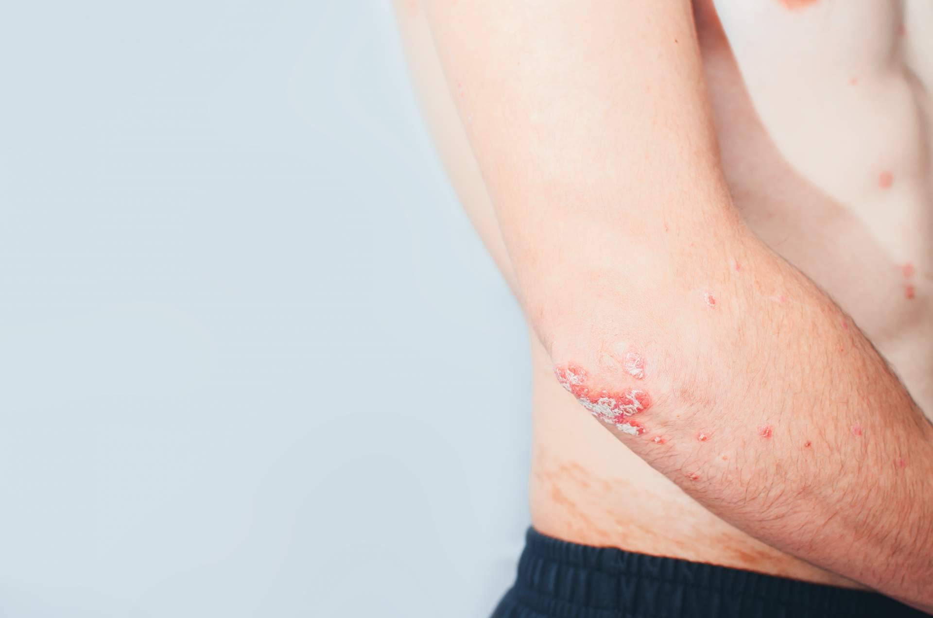 Tratamiento efectivo para la psoriasis con la línea de productos Soriasel