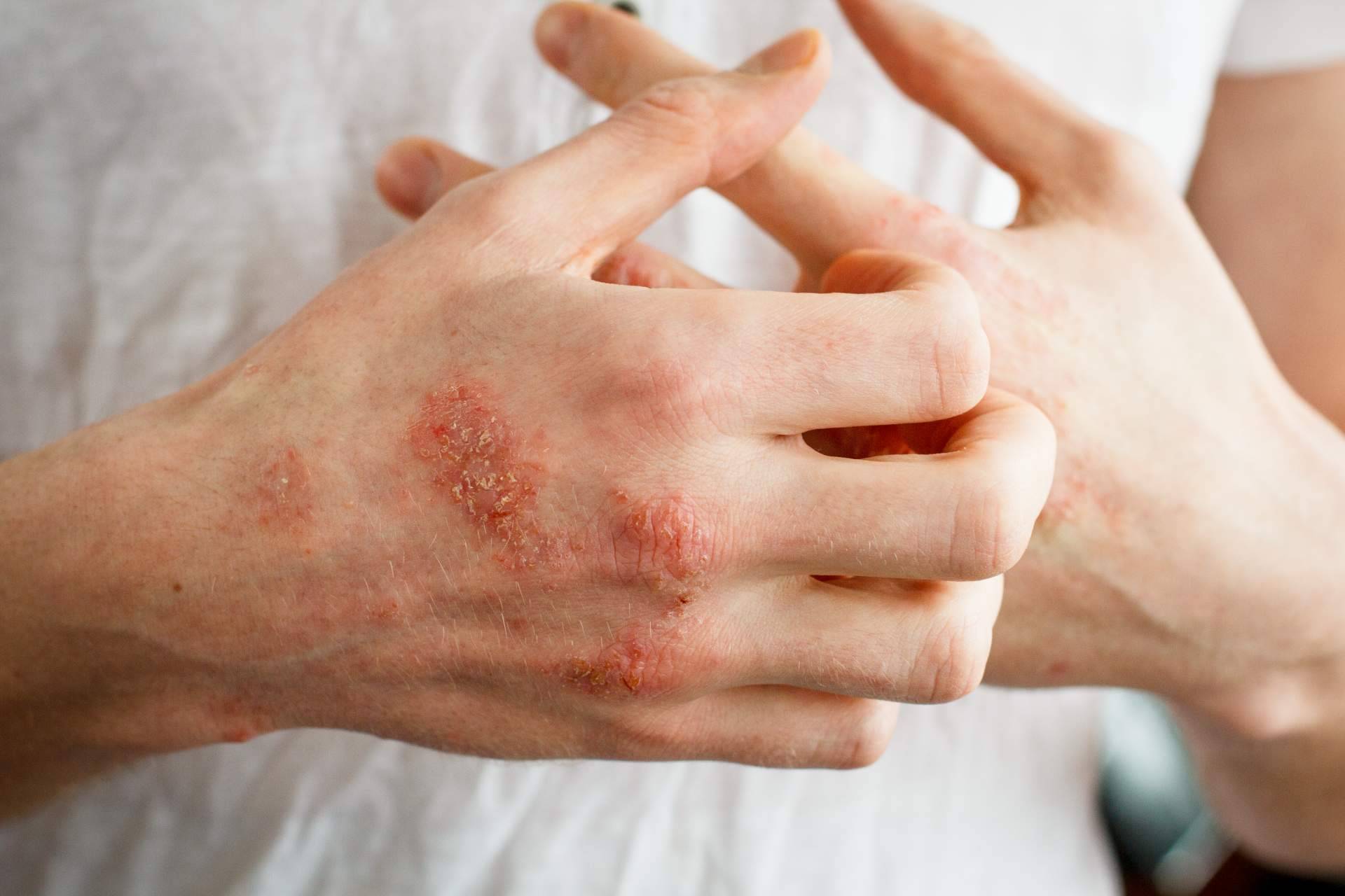 ¿Eczema atópico o eczema de contacto?, por Laboratorio Géomer