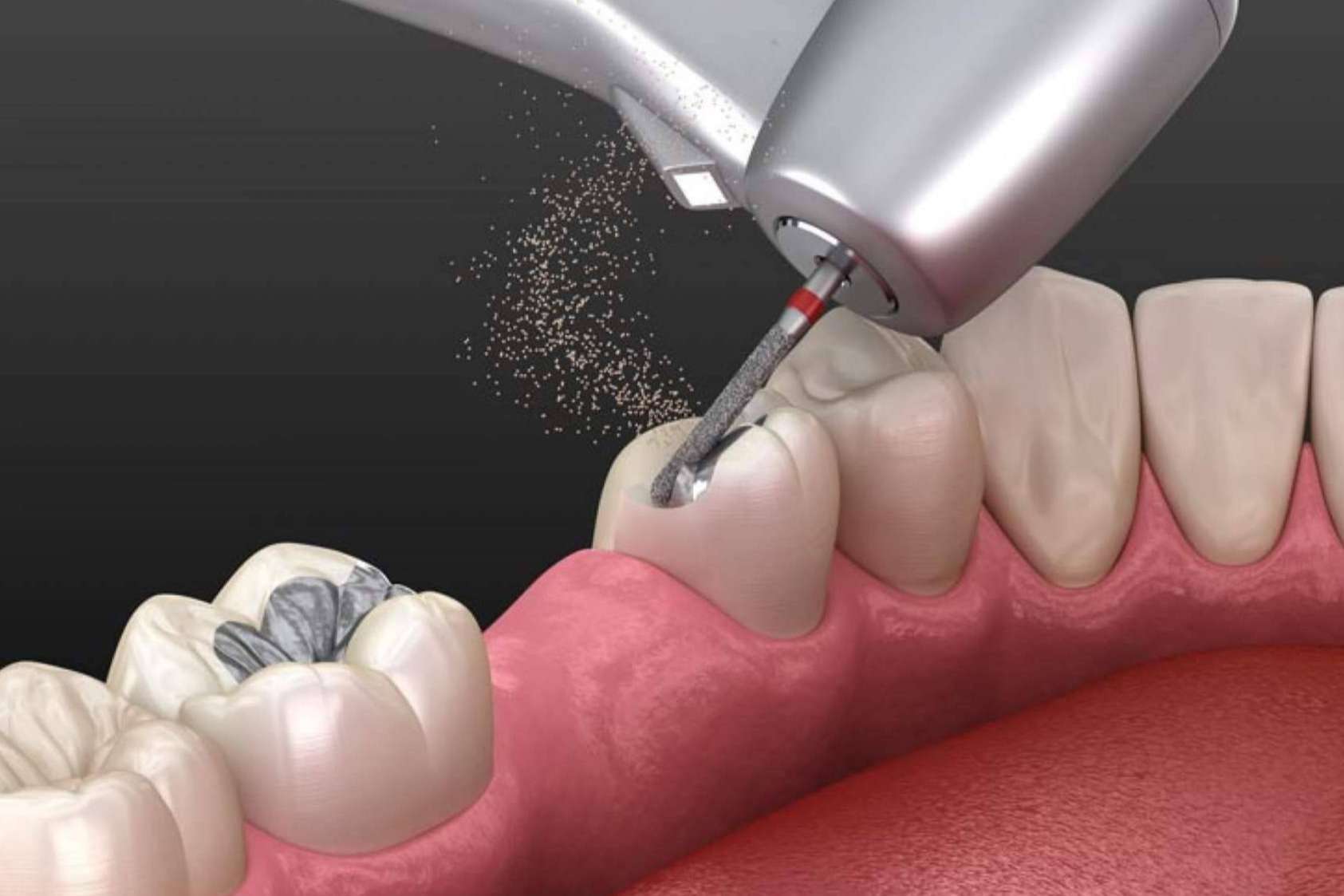 La calidad de las fresas dentales contribuye en una mayor duración del instrumento, según Precisión Médica Dental