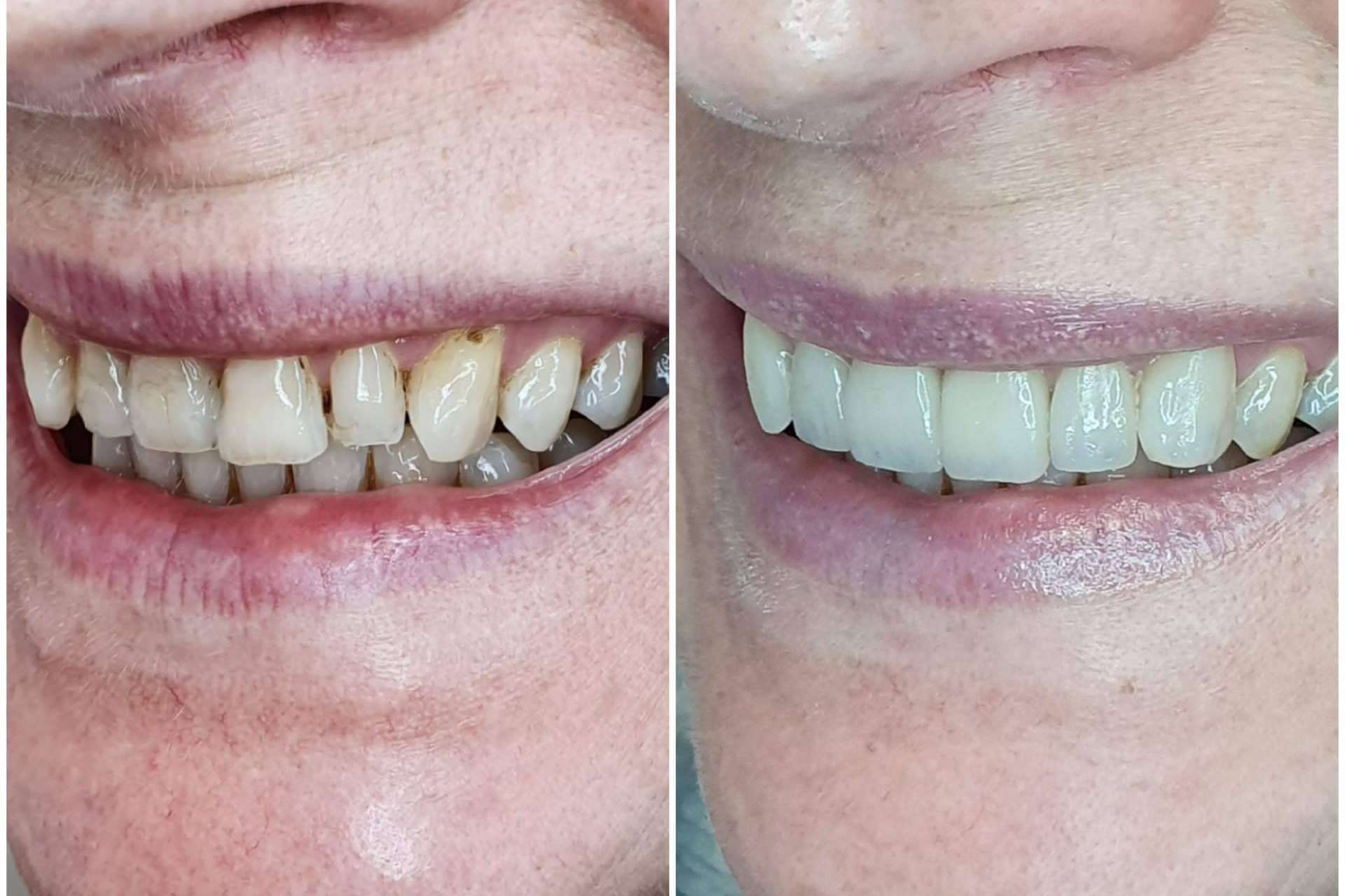 Dentinova permite lograr una estética dental adecuada en dos visitas