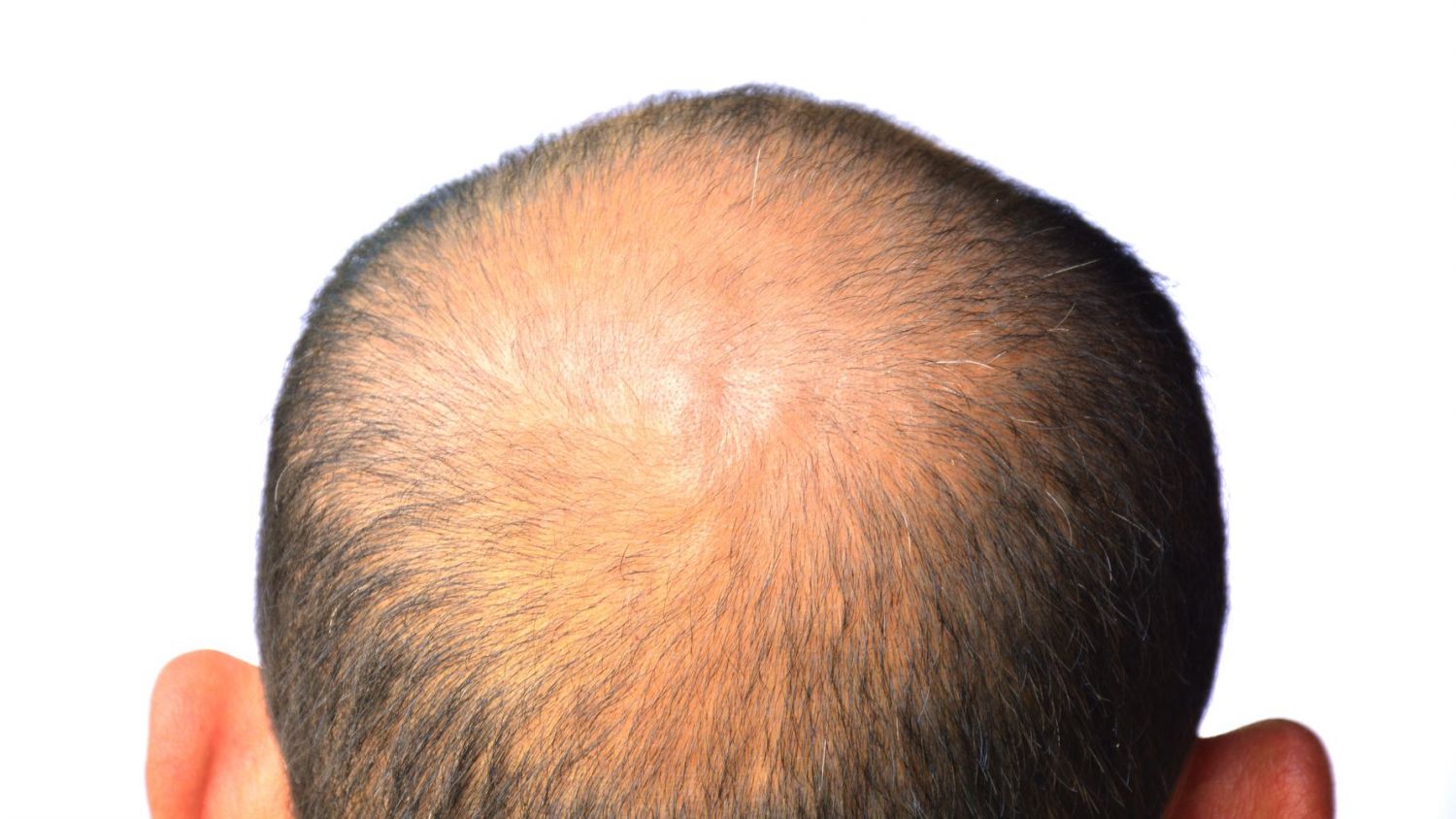 Cómo recuperar el pelo o evitar la caída con estos tratamientos