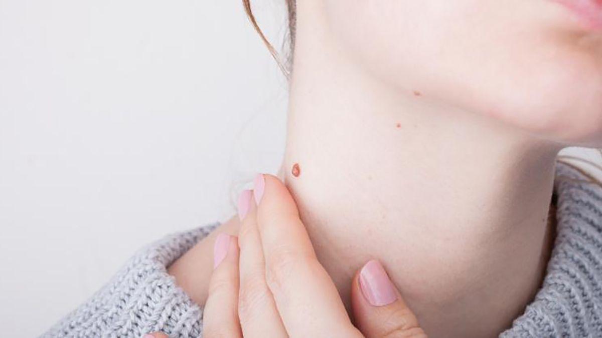 Verrugas en el cuello: por qué salen y cómo eliminarlas