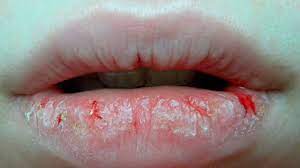 labios agrietados