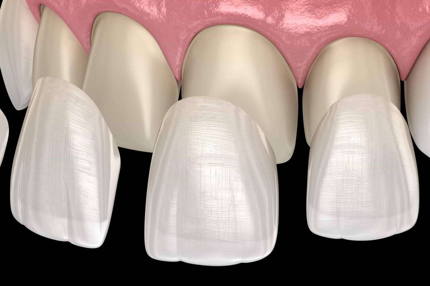 Conseguir una sonrisa Hollywood de la mano de Dentinova