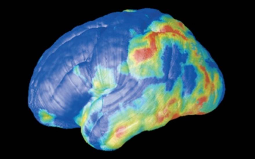 Investigación para la detección precoz del Alzheimer: Estudios de imagen neuronal de proteína Tau